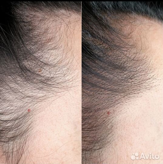 Трихопигментация