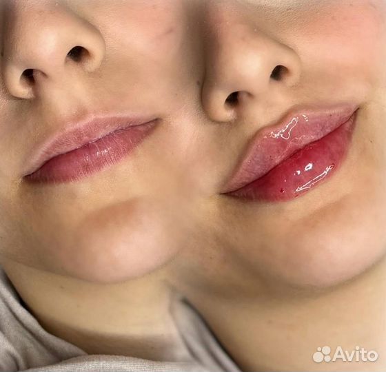 Контурная пластика губ