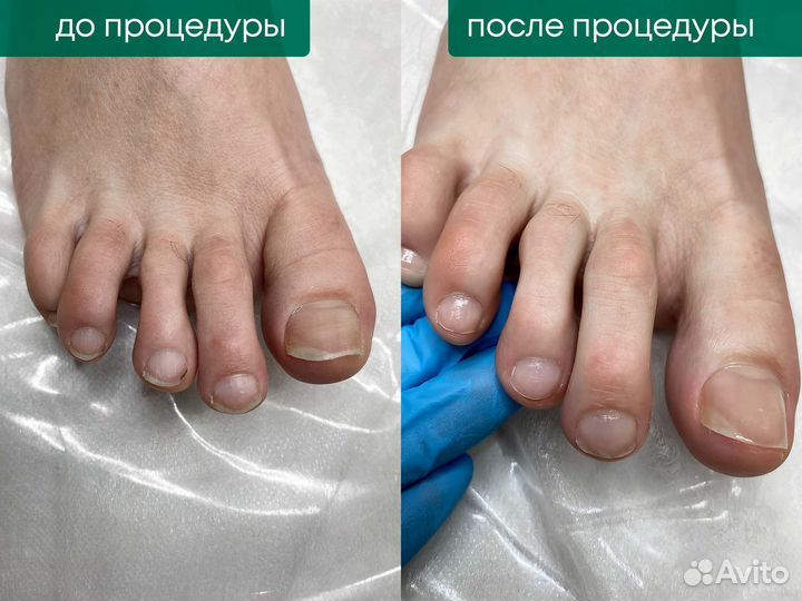 Подолог, лечение грибка, вросшие ногти, мозоли