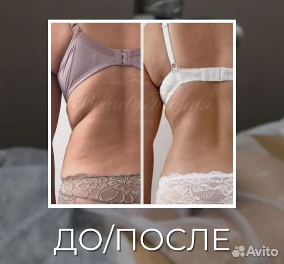 Криолиполиз тела