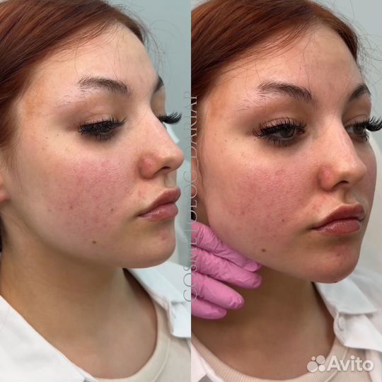 Увеличение губ