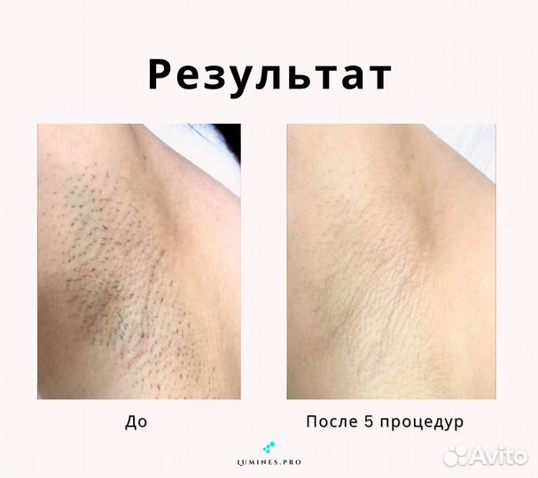 Диодный лазер Lumines Макс Ван 1200W