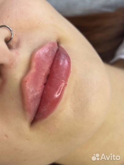 Увеличение губ