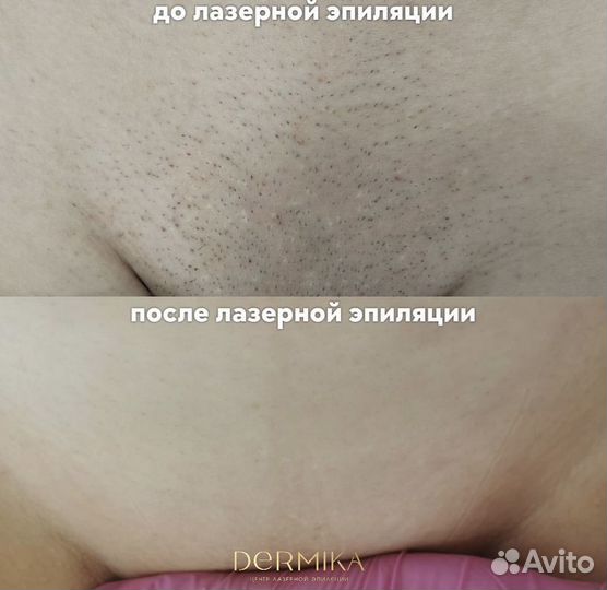 Лазерная эпиляция