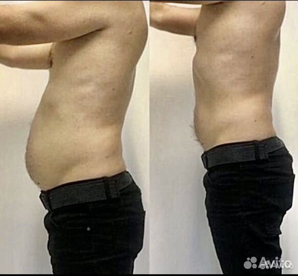 Криолиполиз для мужчин на новейшем аппарате