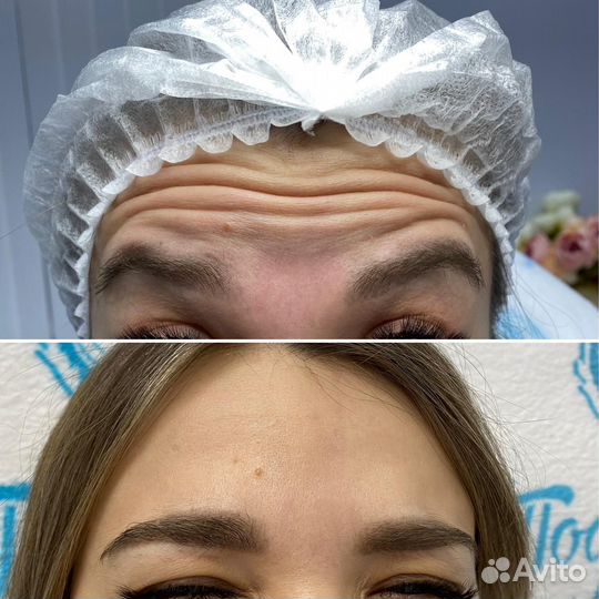 Ботокс/ Ботулинотерапия