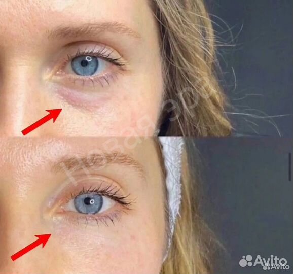 Игольчатый РФ лифтинг. Morpheus 8