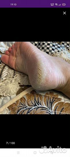 Удаление ороговевший кожи