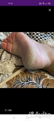 Удаление ороговевший кожи