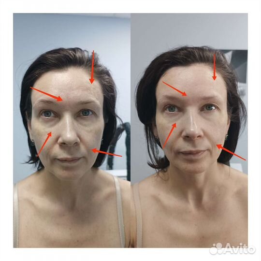 LPG, массаж тела и лица, коррекция фигуры