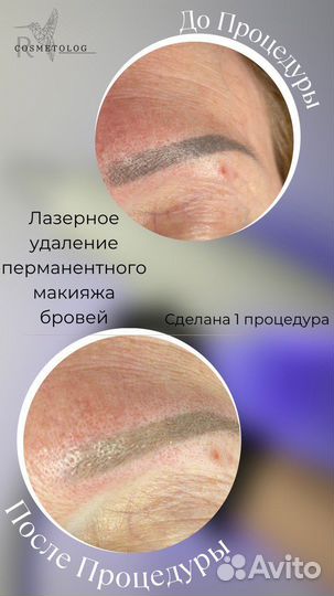 Модели на лазерное удаление Тату и перманента