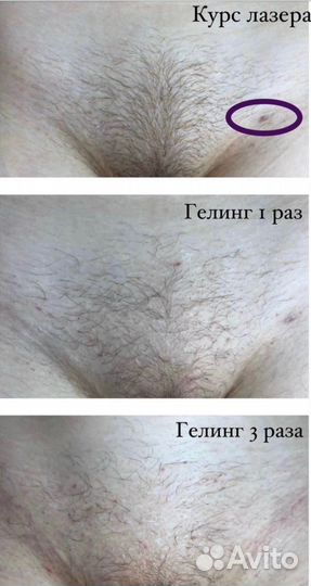 Гелинг депиляция
