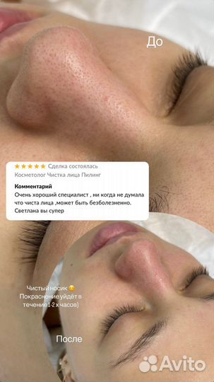 Комбинированная чистка лица