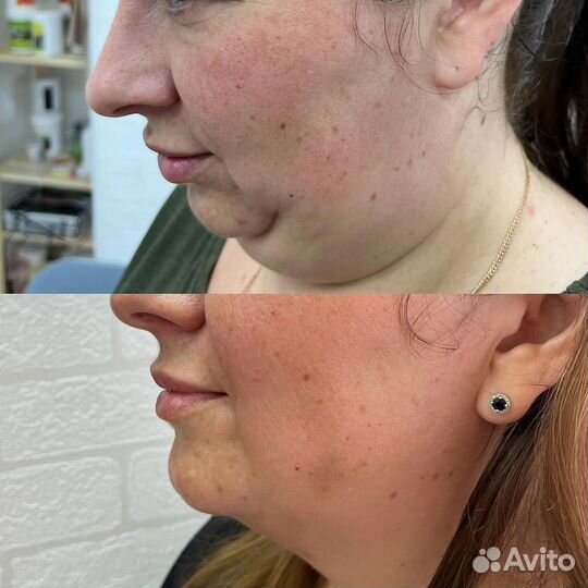 Липолитики, худое лицо, худое тело