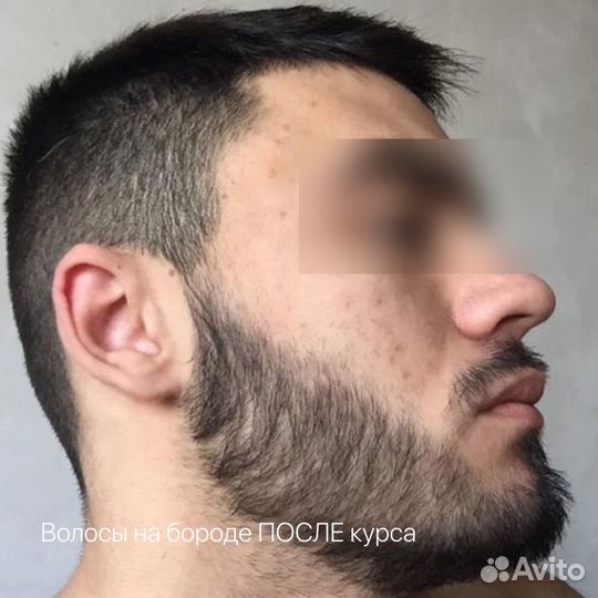 Набор для роста волос