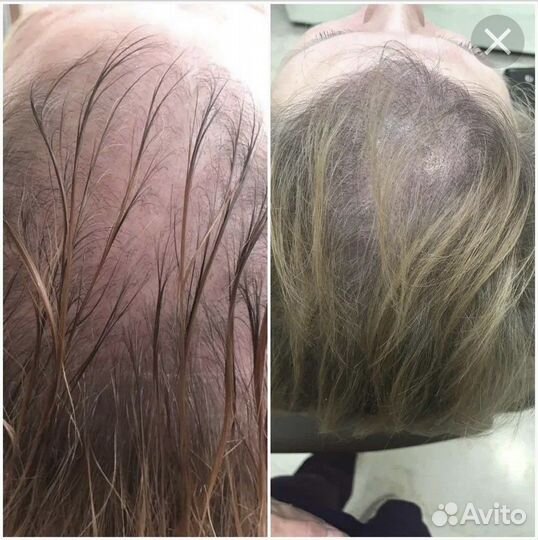 Трихопигментация