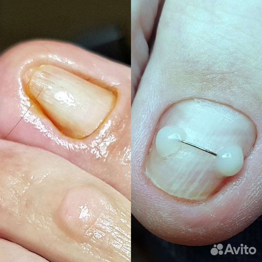 Медицинский педикюр подолог