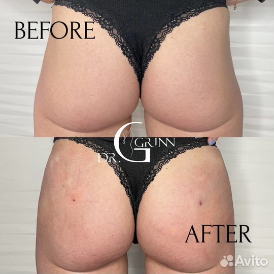 Увеличение ягодиц/груди
