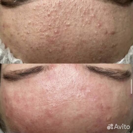 Косметолог чистка лица