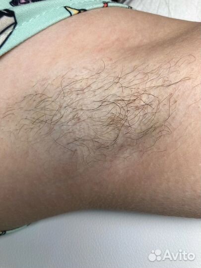 Электроэпиляция