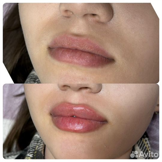 Косметолог /увеличение губ/ ботокс/мезо /плазма