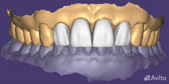 Удалённое моделирование в exocad
