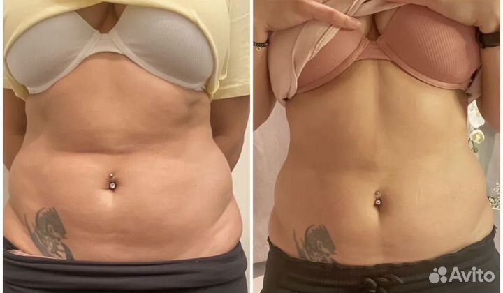 Электромагнитная стимуляция пресса (emsculpt)