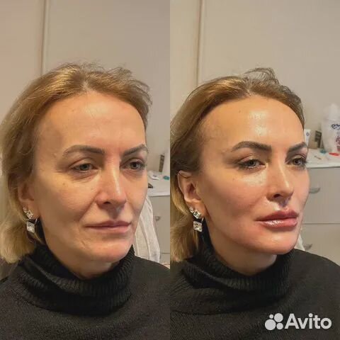 Минус 15 лет за процедуру. СМАС лифтинг