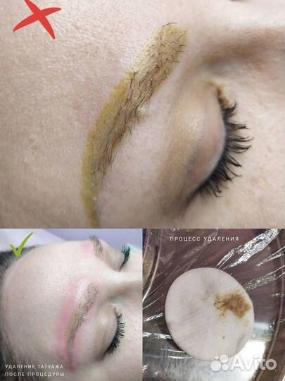 Удаление татуажа ремувером