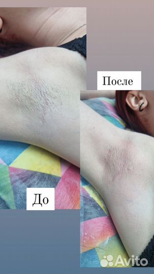 Шугаринг депиляция