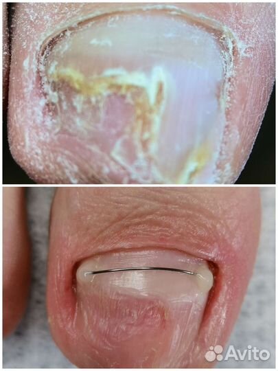 Подолог Педикюр