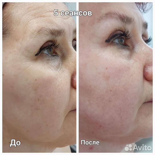 Массаж лица и тела, косметология, Мадеротерапия