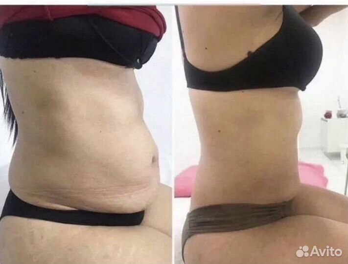 Плоский живот за 1 процедуру