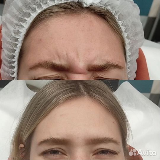 Модель на ботокс лица