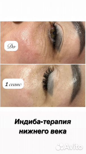 Индиба похудение, коррекция