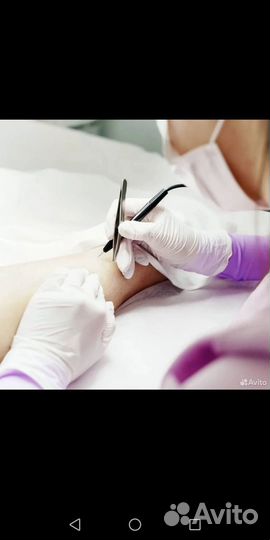 Электроэпиляция