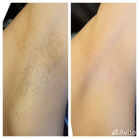 Шугаринг. Депиляция воском