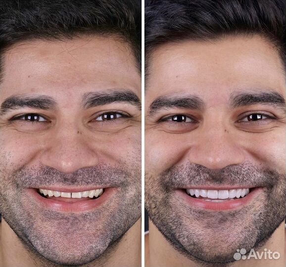 Композитные виниры