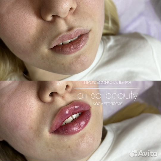 Увеличение губ, увлажнение 0,5мл; 1мл