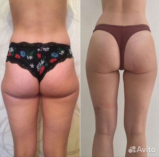 Антицеллюлитный массаж