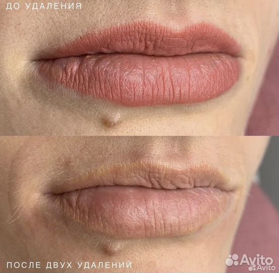 Лазерное удаление татуировок/татуажа