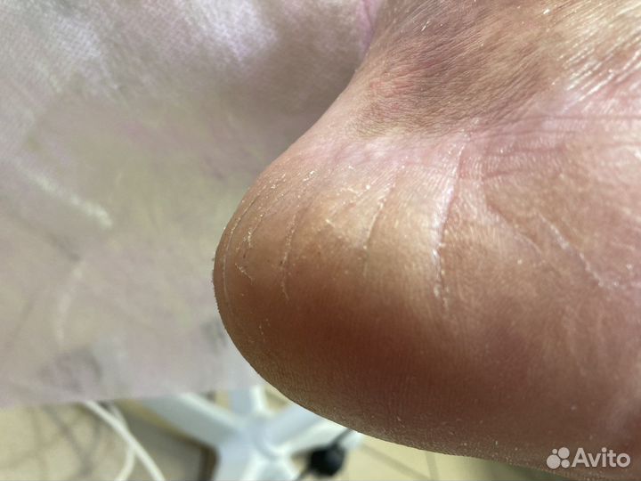 Педикюр, подолог,вросший ноготь, трещины,мозоли