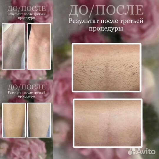 Аппаратный массаж, LPG, Vela Shape, Лаз. Эпиляция