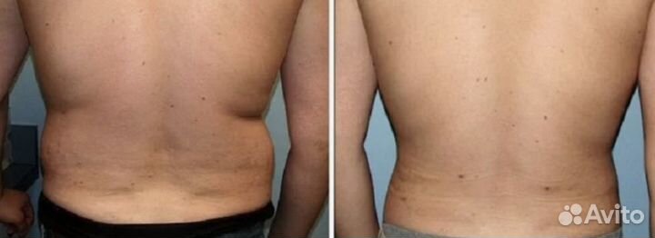 Липосакция, жиротоп и похудение Липосоникс