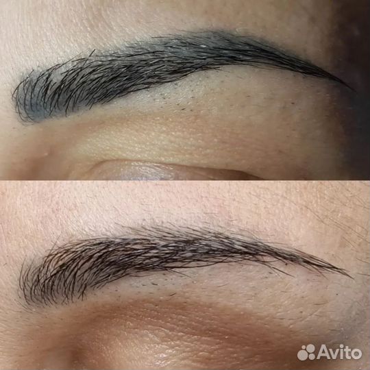 Удаление татуажа и тату лазер / ремувер