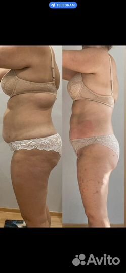 Коррекция фигуры снижение веса