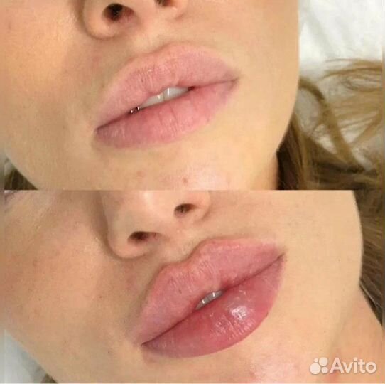 Увеличение губ
