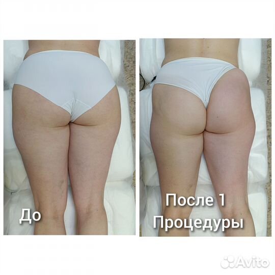 Аппаратное похудение