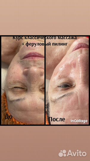 Косметолог, массаж лица, пилинг BioRePeel