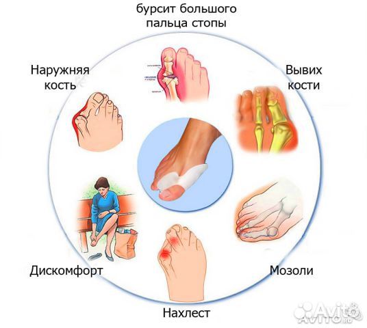 Силиконовый фиксатор от косточки на большом пальце
